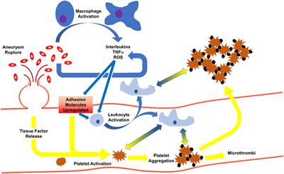 The Role of Thromboinflammation in Delayed Cerebral Ischemia after Subarachnoid Hemorrhage